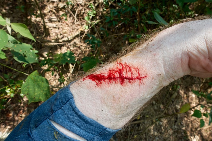 Man's arm with bloody cut